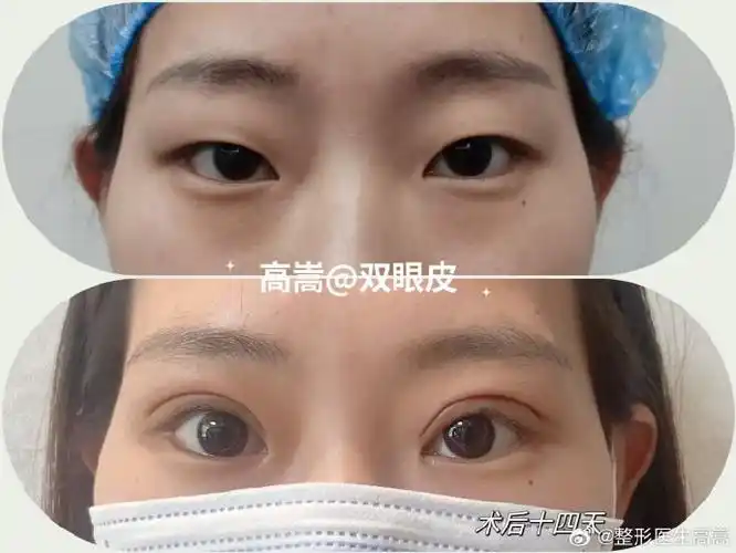 双眼皮 提肌手术…姑娘用力睁眼也不能完全暴露黑眼球,说明提肌无力
