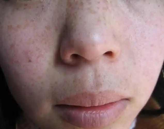 张女士34岁生下二胎,孕期皮肤就渐渐长出了一些斑,开始以为是妊娠期间