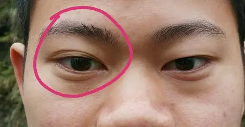 上眼皮有点肿,有一个多月了,是什么原因?