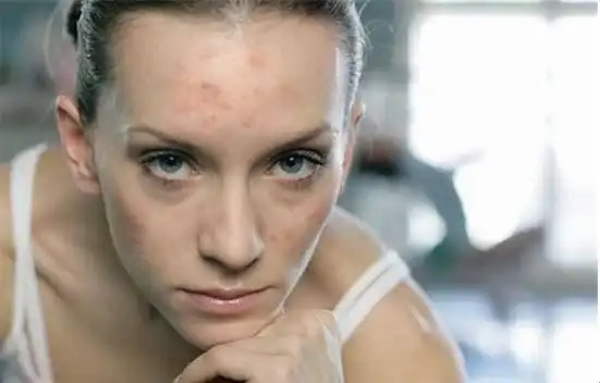 敏感性皮肤怎么调理摆脱敏感困扰