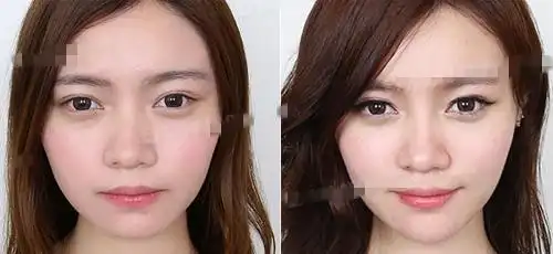 注射玻尿酸隆鼻前后对比效果图片和手术过程案例分享