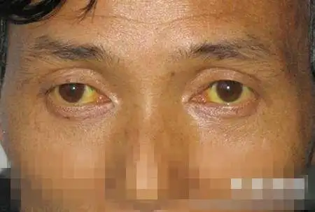 巩膜,黏膜,皮肤及其他组织被染成黄色,黄疸是肝不好常见的表现,由于