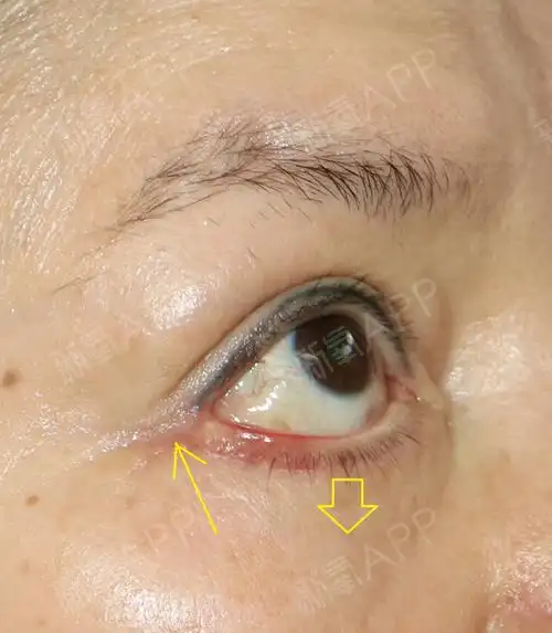 案例介绍该患者做了下眼睑除皱术造成眼睑下翻的失败后_圈子-新氧美容
