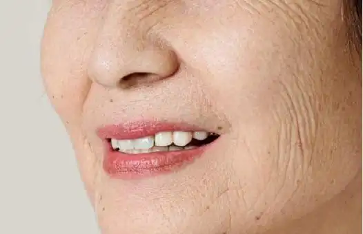 皮肤出现这些皱纹,要上心了|肌肉|细纹|鱼尾纹|法令纹|皮肤科医生