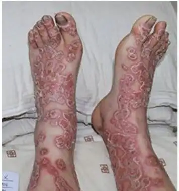 是一种非常恐怖恶心的皮肤病,主要通过苍蝇来传播,能够寄生在人体之中