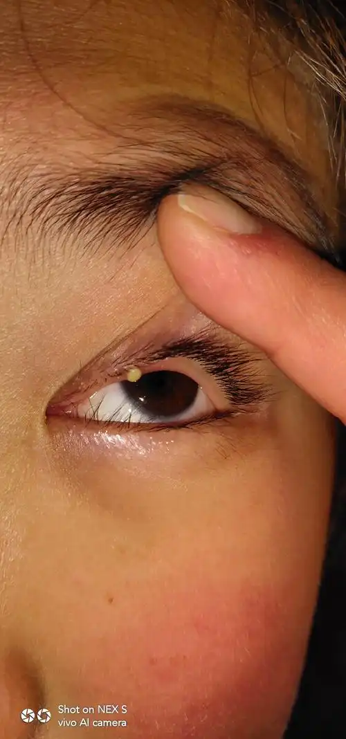 我女儿的眼睑长麦粒肿了,刚刚发现,不知道怎么回事,怎么才能好啊?