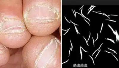 健康养身★7岁女童爱咬指甲.半夜屁眼钻出大量蛲虫!家长一定要注意.