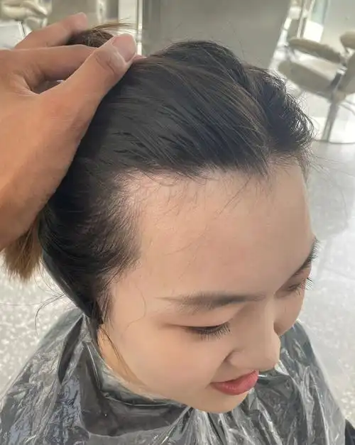 22年的秃鬓角通过胎毛刘海儿治好了