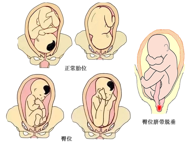 孕妇臀位破水千万别乱动!