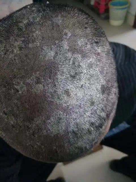 皮肤癣的图片症状