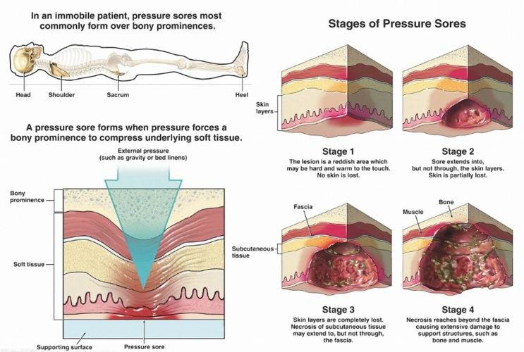 压疮一招治好20天痊愈?网传偏方害惨人!反溃烂露骨_患者