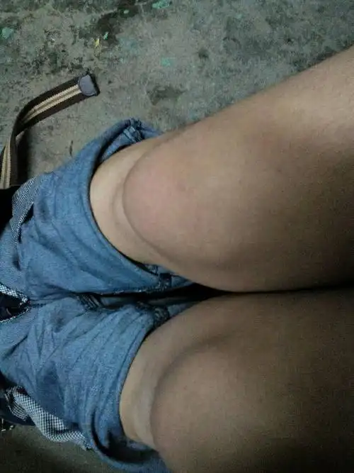 我膝盖积水,和我干的工作有关吗?