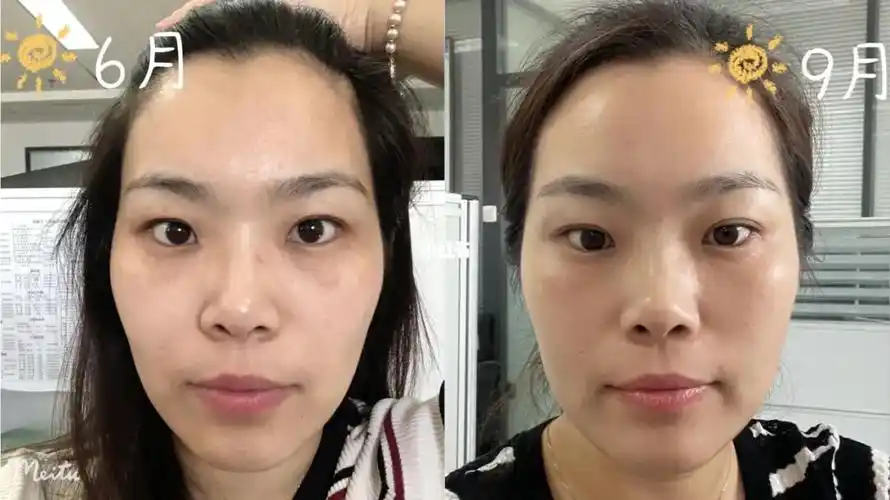 上个对比图,还是有效果的_工作_苹果肌_脸颊凹陷_美妆_护肤_护肤其他