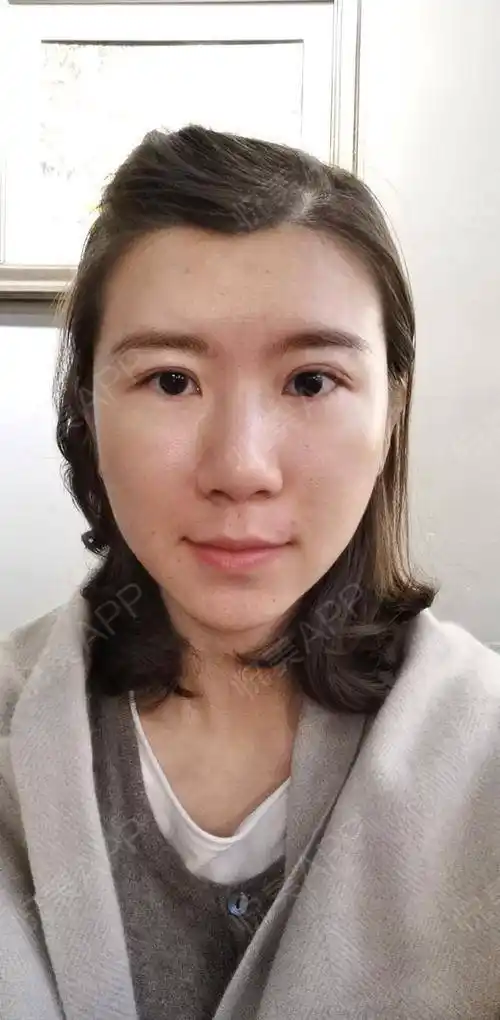 自体脂肪填泪沟术后43天_自体脂肪面部填充术后43天_面部填充术后43天