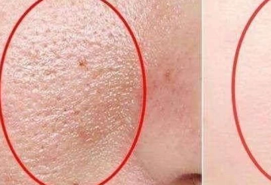 有的一些水分和不使皮肤过于干枯就不得已而分泌油脂来锁住脸上的水分