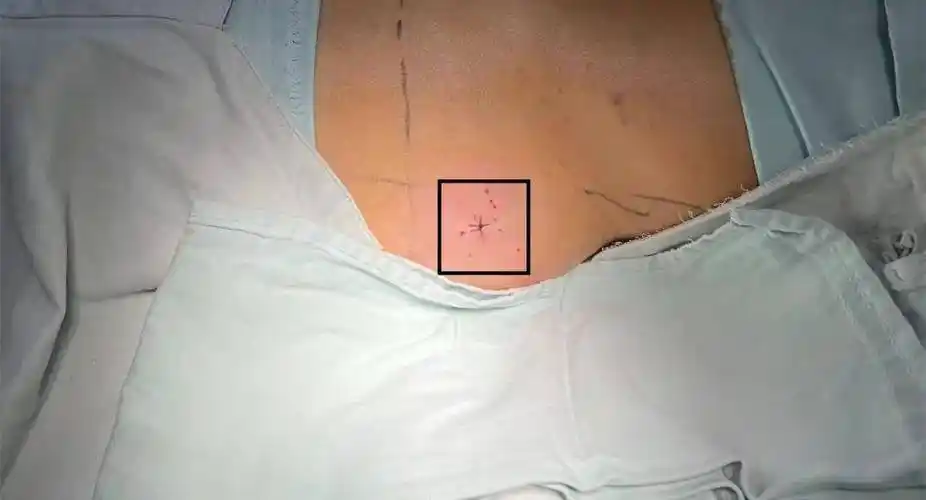 考虑到骨盆后环损伤,切开复位钢板内固定术存在出血多,时间长,术后