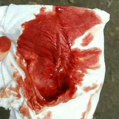 推荐回答                     我现在怀孕两个月,中间已经出血20天了