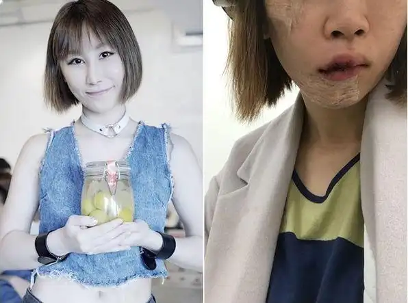香港女歌手意外跌倒毁容整形又失败后回家又遭家暴