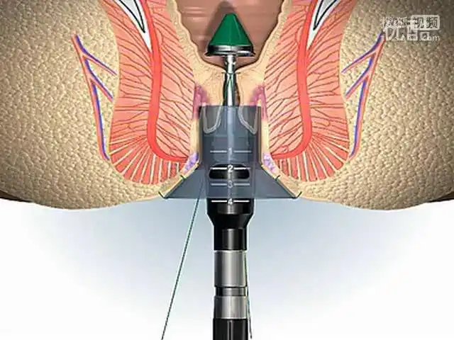 一次性痔疮吻合器-pph技术动画-动漫视频-搜狐视频
