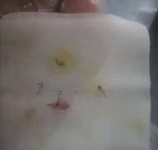 22岁,包皮包茎,记录我的包皮手术亲身经历_进行_医生_小时候