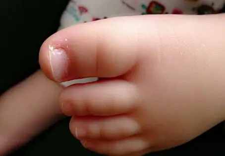 宝宝指甲脱皮怎么回事