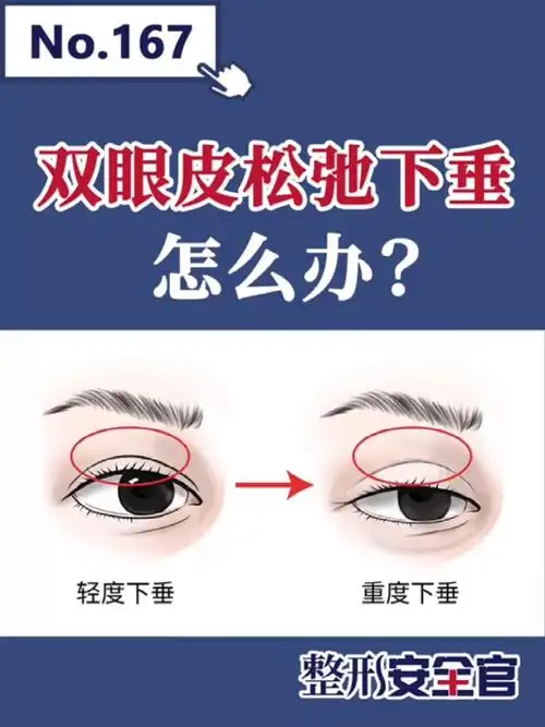 双眼皮松弛下垂怎么办