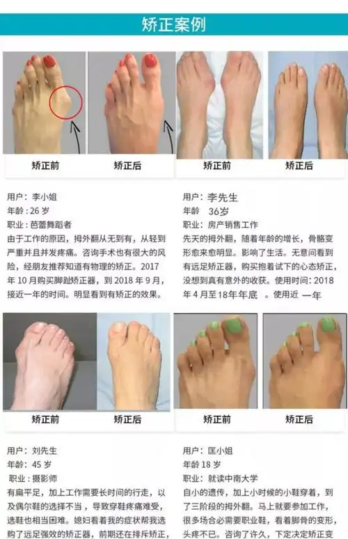 高跟鞋导致脚趾外翻又丑又疼用这大脚骨终结者24小时无痛矫正