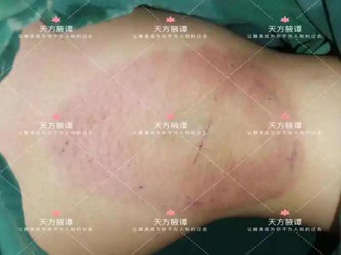 改良型小切口腋臭根治手术之所以可以称之为改良,是因为其不同于小