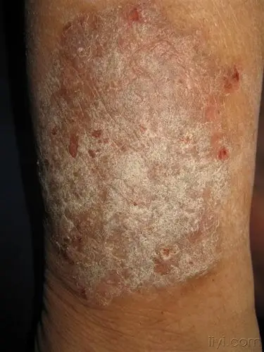 看图识病-----------神经性皮炎 - 皮肤及性传播疾病讨论版 - 爱爱医