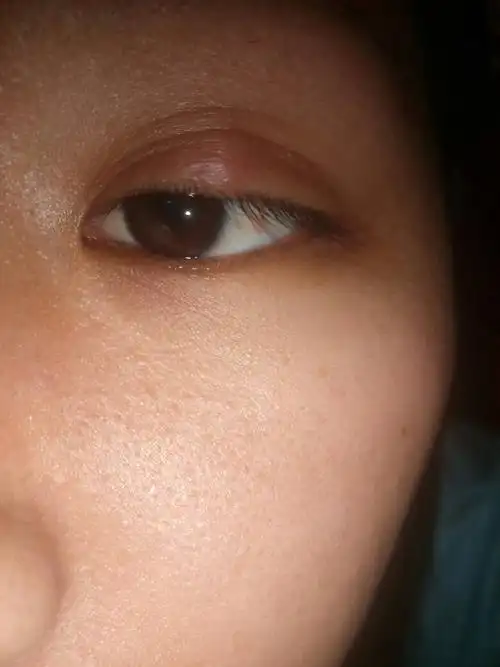 前几天眼睛上皮长了个疙瘩,听同事说要去做切割手术,请问这个是什么来