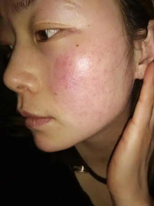 姐妹们是不是有红红的血丝暴露在脸上,像僵尸的皮肤一样,你知道什么是