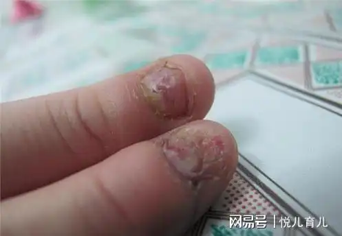 从小咬指甲的娃长大后咋样了专家无非是这2结果