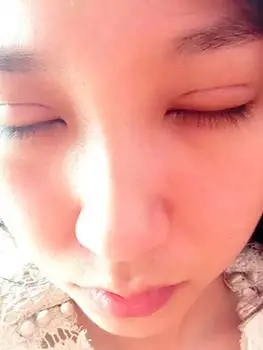 切开双眼皮术后效果萌萌哒(4)