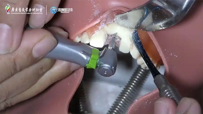 种植牙模拟手术实操模型颌骨上植入切牙及左下第一磨牙