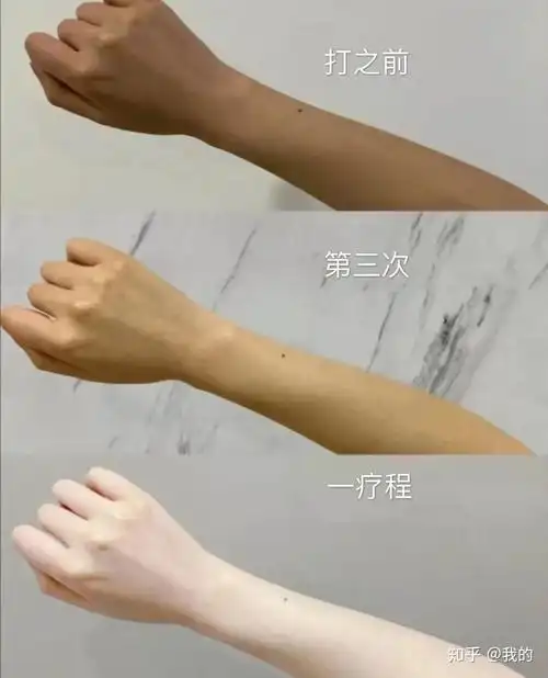打美白针前后真实对比图片我在网上了查了大量资料,了解到美容医院