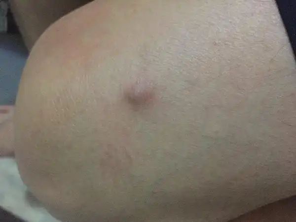 大腿接近膝盖上方长个肉包,懂的帮我看看,不痒不痛,按着有点痛.