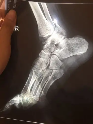 10月15日手术.已经术后20天 请问什么时候可以走路,片子是术后3天