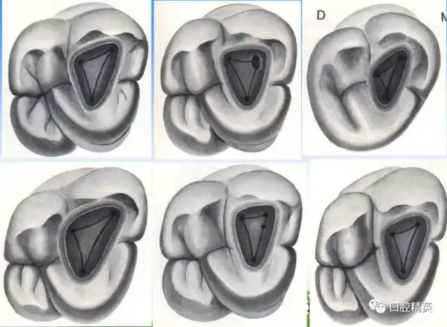 详解各牙位的开髓整理版