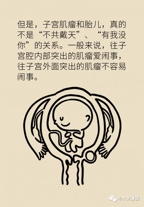 漫画 | 正确认知子宫肌瘤