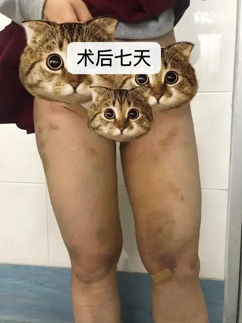 我来说说抽脂三个月后的情况