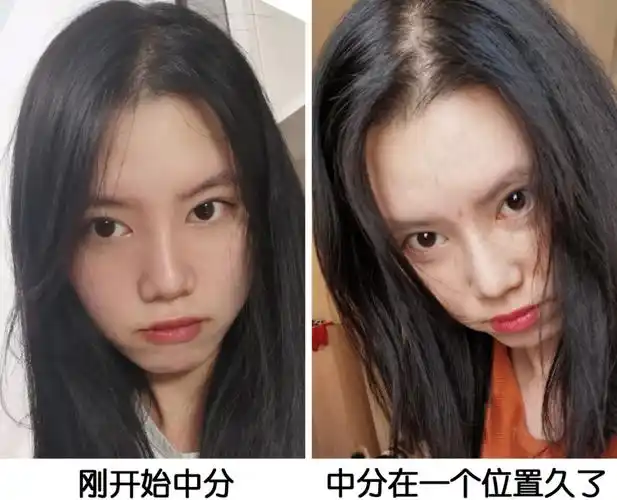 发际线太高了怎么挽救如何改善发际线高的问题简单不复杂