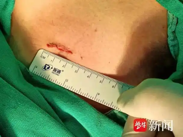 张医师为小孙精心设计了微创手术方案,并成功实施了电视胸腔镜下左侧