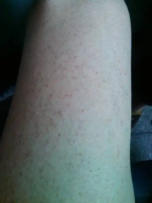 大腿毛孔汗毛长不出来怎么办?红色得点点,不通不痒.