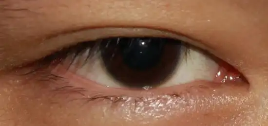 的眼睛是浑浊的,发黄的,甚至还有血丝,眼袋大,眼球干涩,就表示贫血了