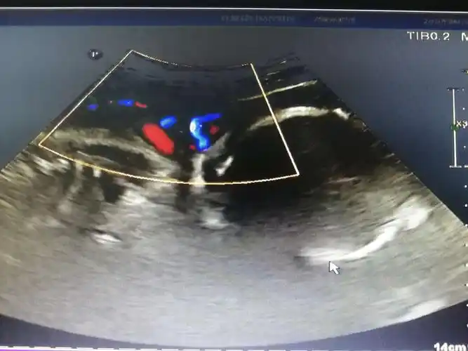 脐带绕颈那些事