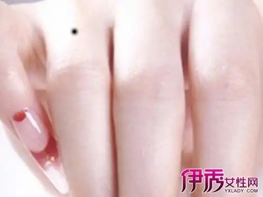 【图】右手手背上有痣图解展示 为你解析手掌痣的含义