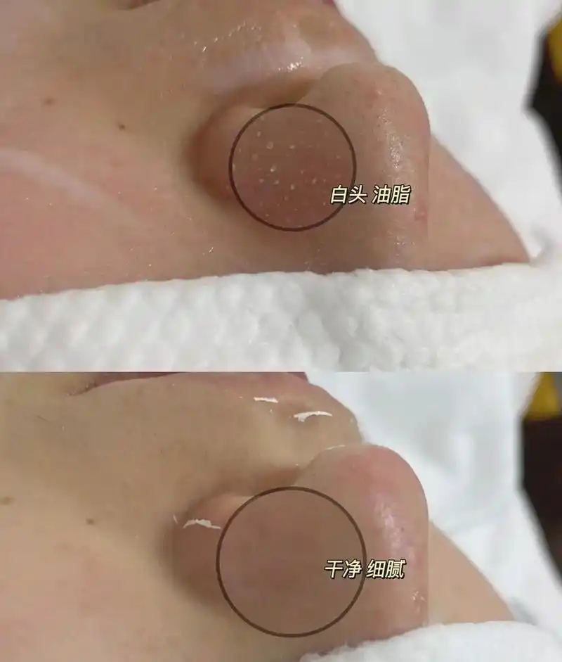 毛孔清洁一次出效果