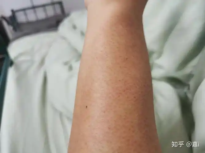 毛孔角化症怎么消除