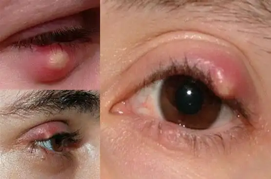 耳尖放血速效治疗麦粒肿