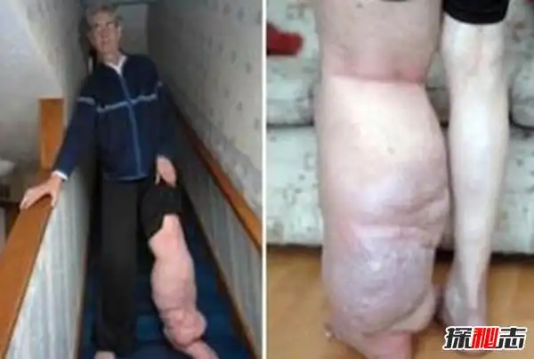 使人体蛉观类似于象的皮肤和腿,一般传染的途径是蚊虫叮咬